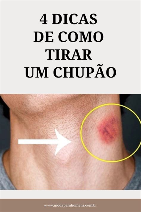 como tirar um chupao|15 truques fáceis de como tirar chupão do pescoço